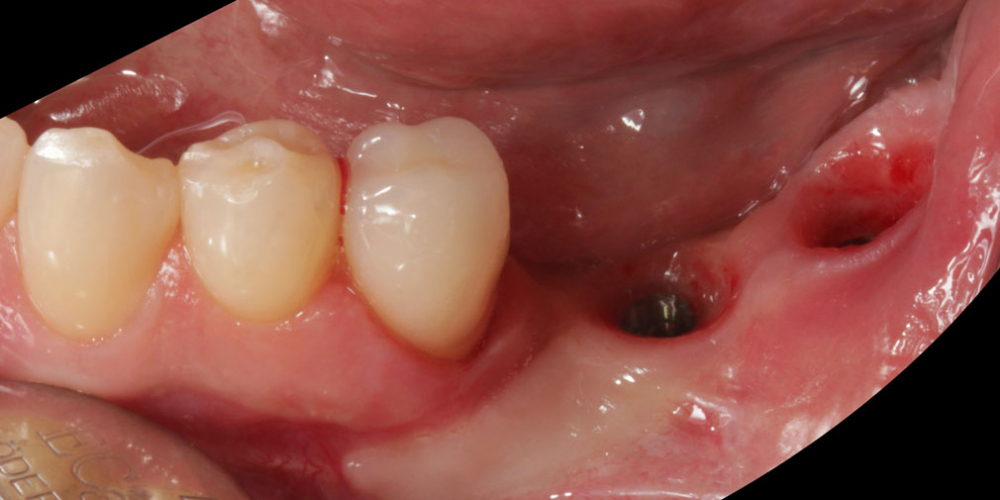 состояние после удаления поднадкостинчного имплантата и одномоментной установки корневидных имплантатов и пластики десны Цельнокерамические реставрации на зубах и имплантатах с опорой на индивидуальные абатменты