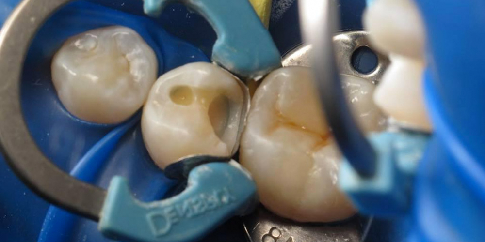 Этап лечения второго зуба. Реставрация двух зубов верхней челюсти