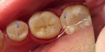Реставрация разрушенного зуба фото после лечения