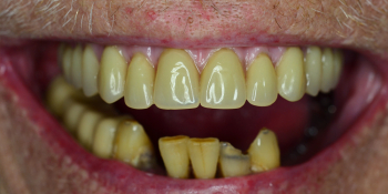 Протезирование верхней челюсти по технологии Все-на-четырех фото после лечения