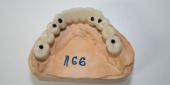 Полное протезирование мостовидными протезами с винтовой фиксацией на имплантатах Dentium фото до лечения