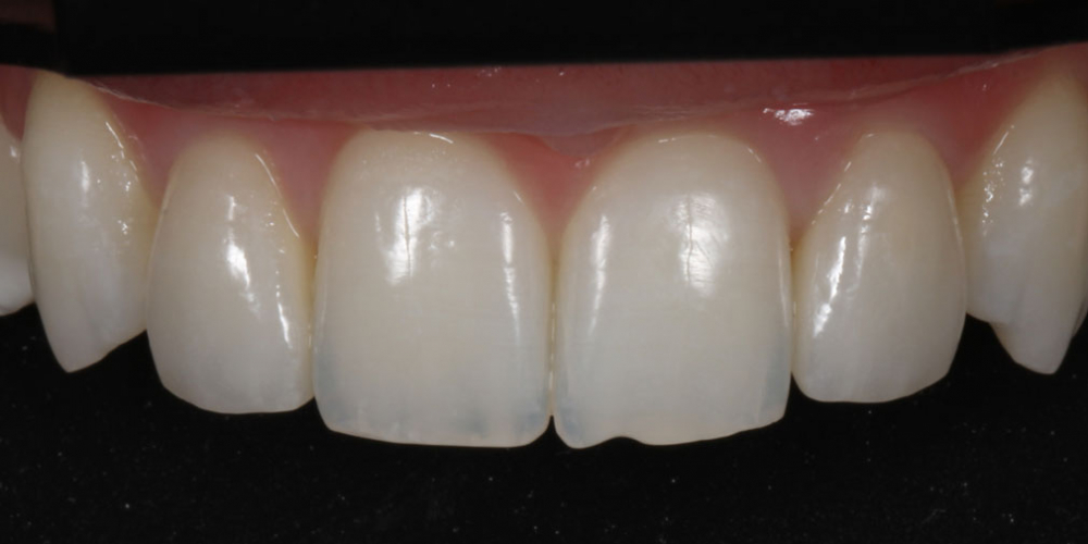 Цельнокерамические реставрации из полевошпатной керамики по технологии рефрактор в полости рта (зубы 12,22) 2 Исправление боковых резцов верхней челюсти керамическими винирами