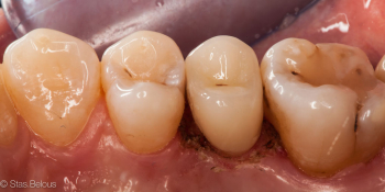 Коронка по технологии CEREC из литий силикатной керамики E.max с индивидуализацией фото после лечения