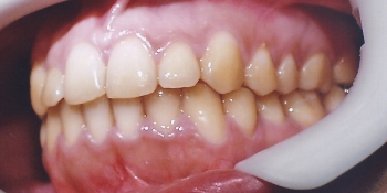 Мезиальный перекрестный прикус со смещением челюсти влево фото после лечения