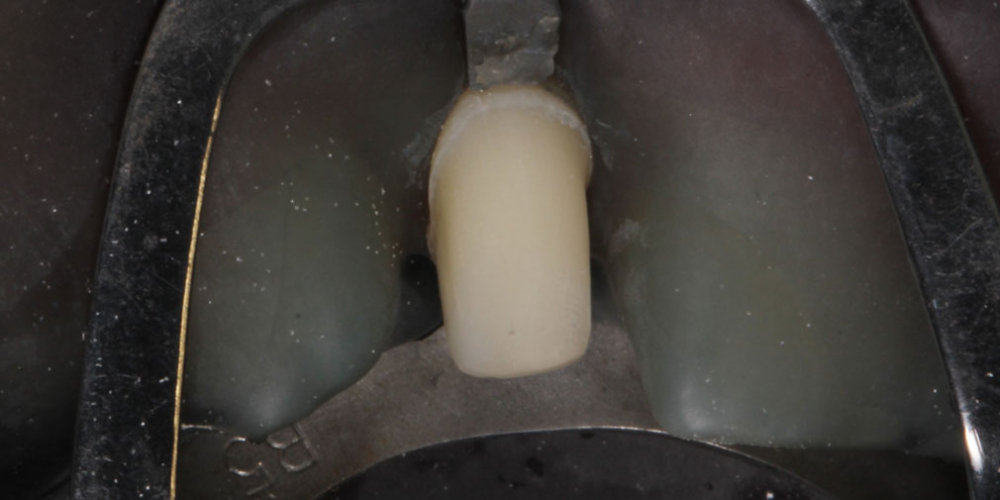 Фиксация постоянных керамических реставраций на зубы Исправление боковых резцов верхней челюсти керамическими винирами