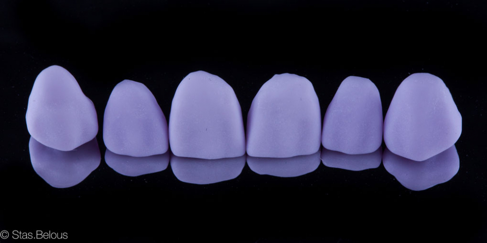 Цельнокерамические коронки, изготовленные на CEREC. Полное воссоздание верхнего зубного ряда