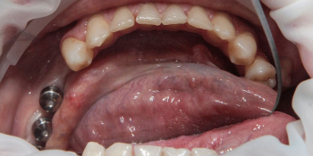 Имплантация и протезирование 3-х зубов из диоксида циркония фото до лечения