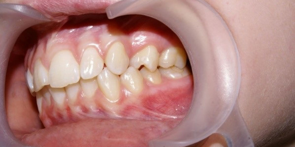 До лечения. Результат выравнивания зубов на нижней и верхней челюстях