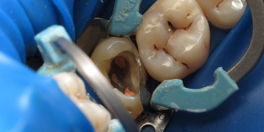  Лечение корневых каналов с последующей художественной реставрацией зуба