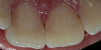 Лечение кариеса на фронтальных зубах с  использованием дентального микроскопа фото после лечения