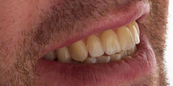 Протезирование зубов на 4 имплантах All-on-4 фото после лечения