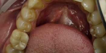 Имплантация Альфа Био одного зуба + металлокерамическая коронка фото после лечения