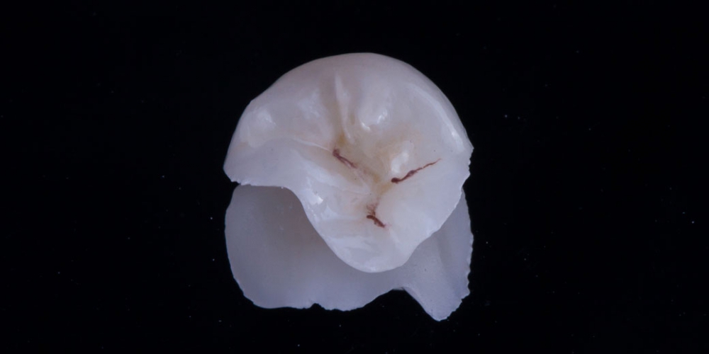 Вкладка выполненная на немецком оборудовании Dentsply Sirona CEREC Восстановление разрушенного зуба керамической вкладкой