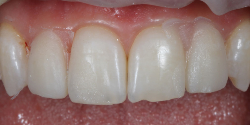 примерка будущих зубов в полости рта (mock - up) Исправление боковых резцов верхней челюсти керамическими винирами