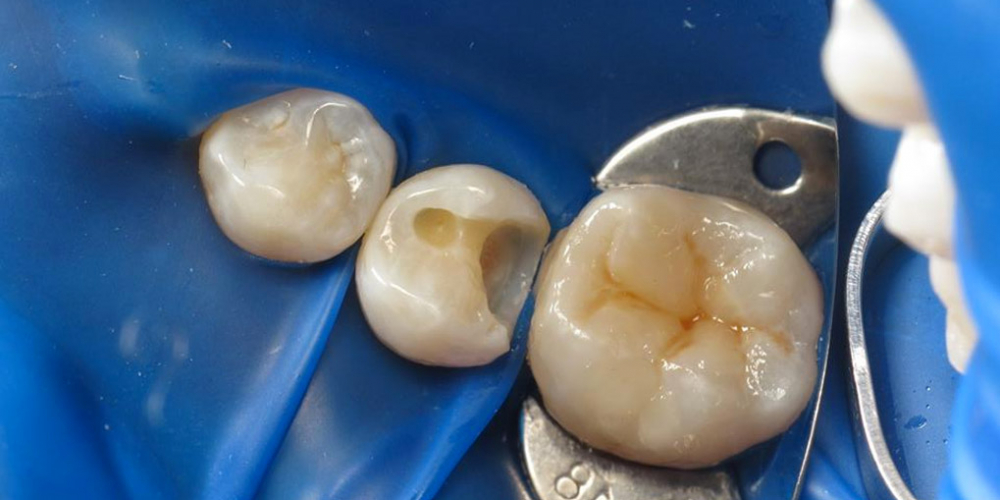Первый этап лечения. Реставрация двух зубов верхней челюсти