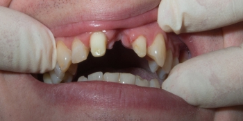 Установка моста из диоксида циркония на передние зубы фото до лечения