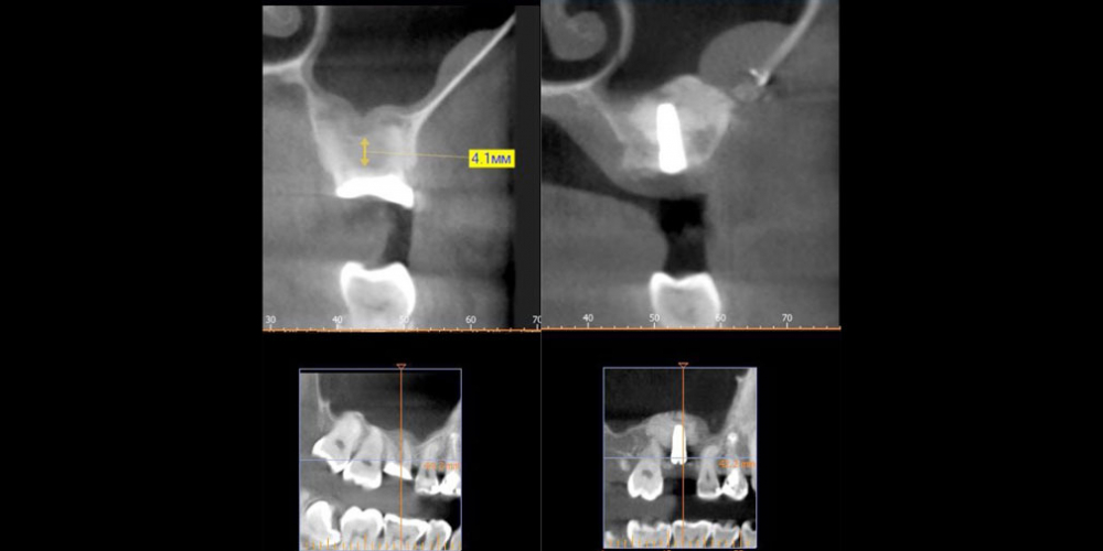 после операции синус - лифтинг с установкой имплантата Восстановление зуба имплантацией + синус-лифтинг - все в один этап