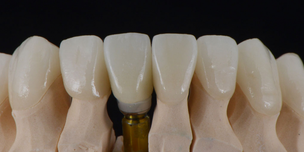 Цельнокерамические реставрации на зубы (виниры, коронки) и импантаты на индивидуальных абатментах из диоксида циркония на модели - нижняя челюсть. Тотальная стоматологическая реабилитация пациента: 12 имплантов + 28 виниров