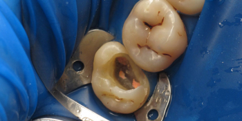 Лечение корневых каналов с последующей художественной реставрацией зуба фото до лечения