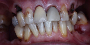 Протезирование зубов на 4 имплантах All-on-4 фото до лечения