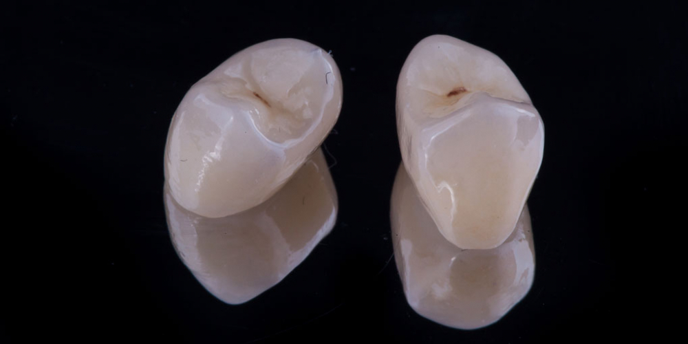 Коронка по технологии CEREC из литий силикатной керамики E.max с индивидуализацией